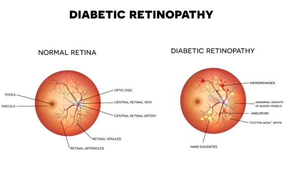 normal retina versus diabetic retinopathy